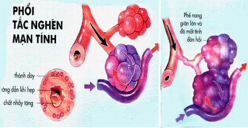 Bệnh phổi tắc nghẽn mãn tính